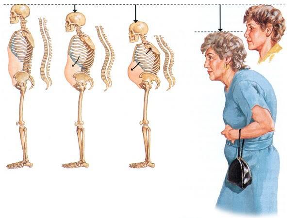 Osteoporoz ve Beslenme